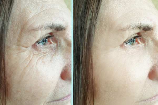 Why Do People Choose HIFU for a Non-Surgical Facelift? 4 How long can HIFU results last Hounslow?