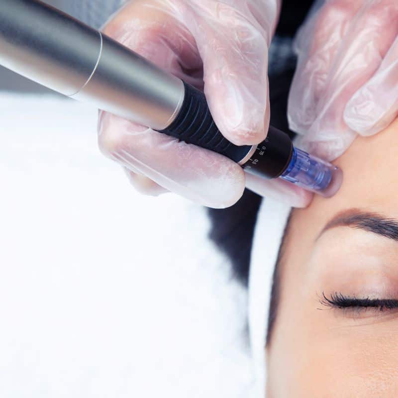 Morpheus8 treatment Hounslow from Lipo Sculpt - Book in today!